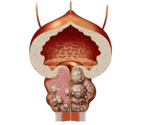 adenom și edem de prostată și tratament cu capsule urosaf