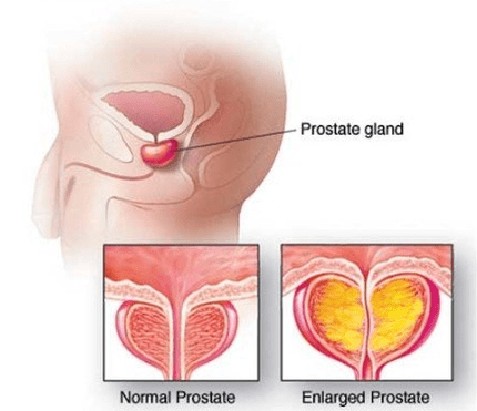 Prostată normală și inflamată
