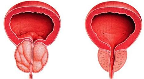 Diferența de prostată bolnavă și sănătoasă